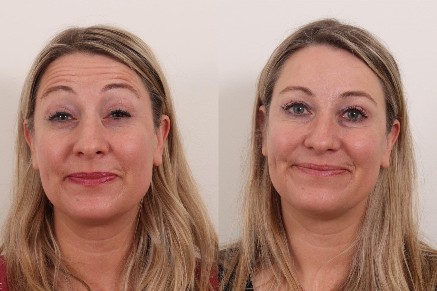 Raised brows Botox before and after