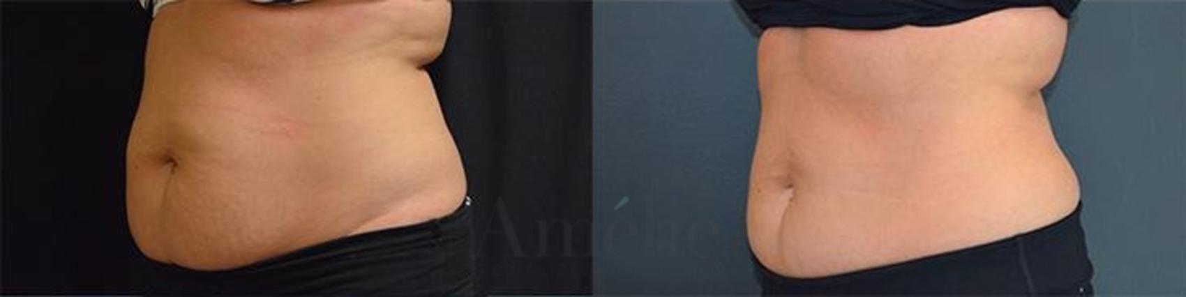 Before & After CoolSculpting® Case 1 Front View in Tigard, Tualatin, Portland, Vancouver (WA), OR