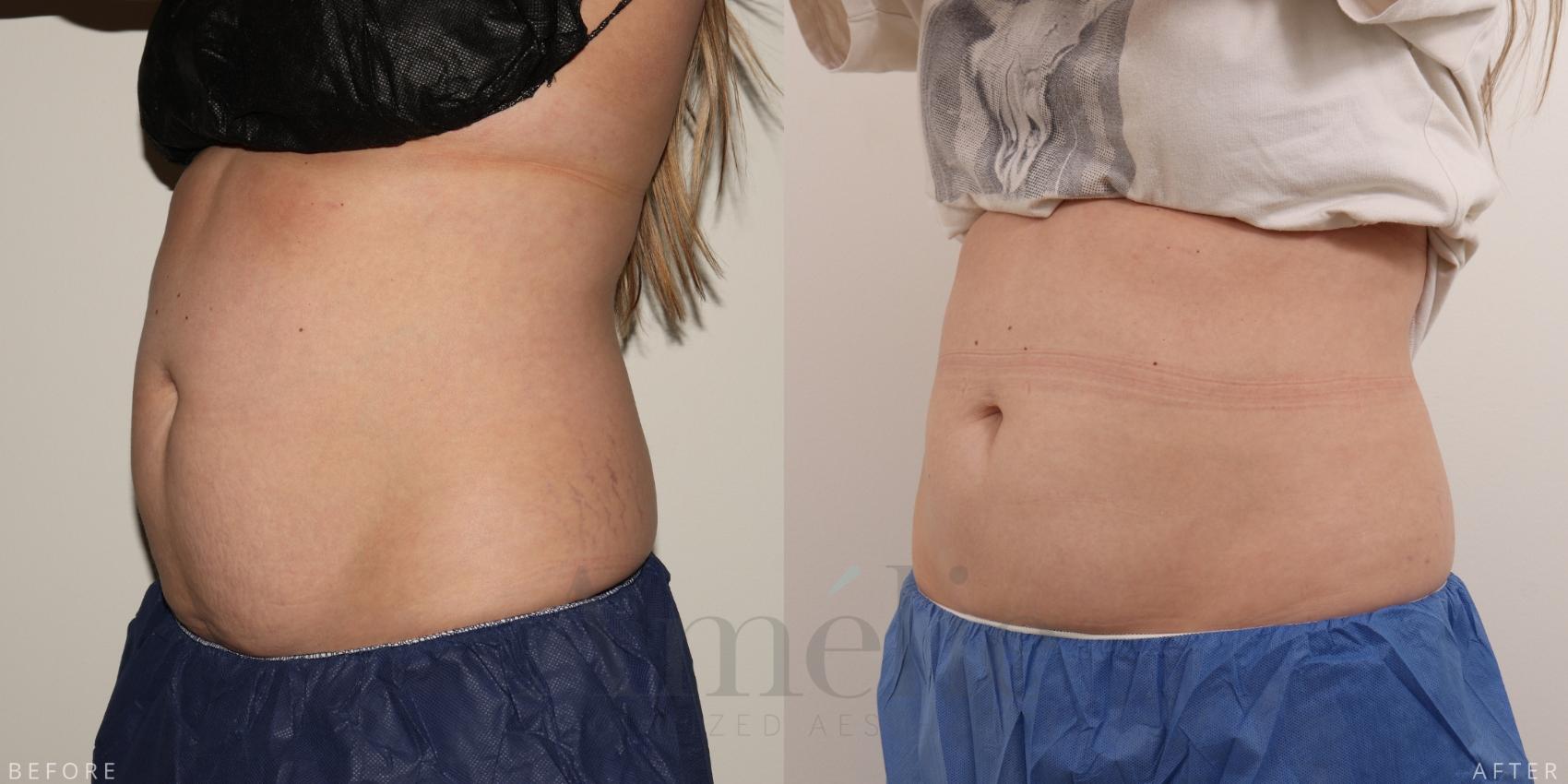 Side view CoolSculpting before and after results 