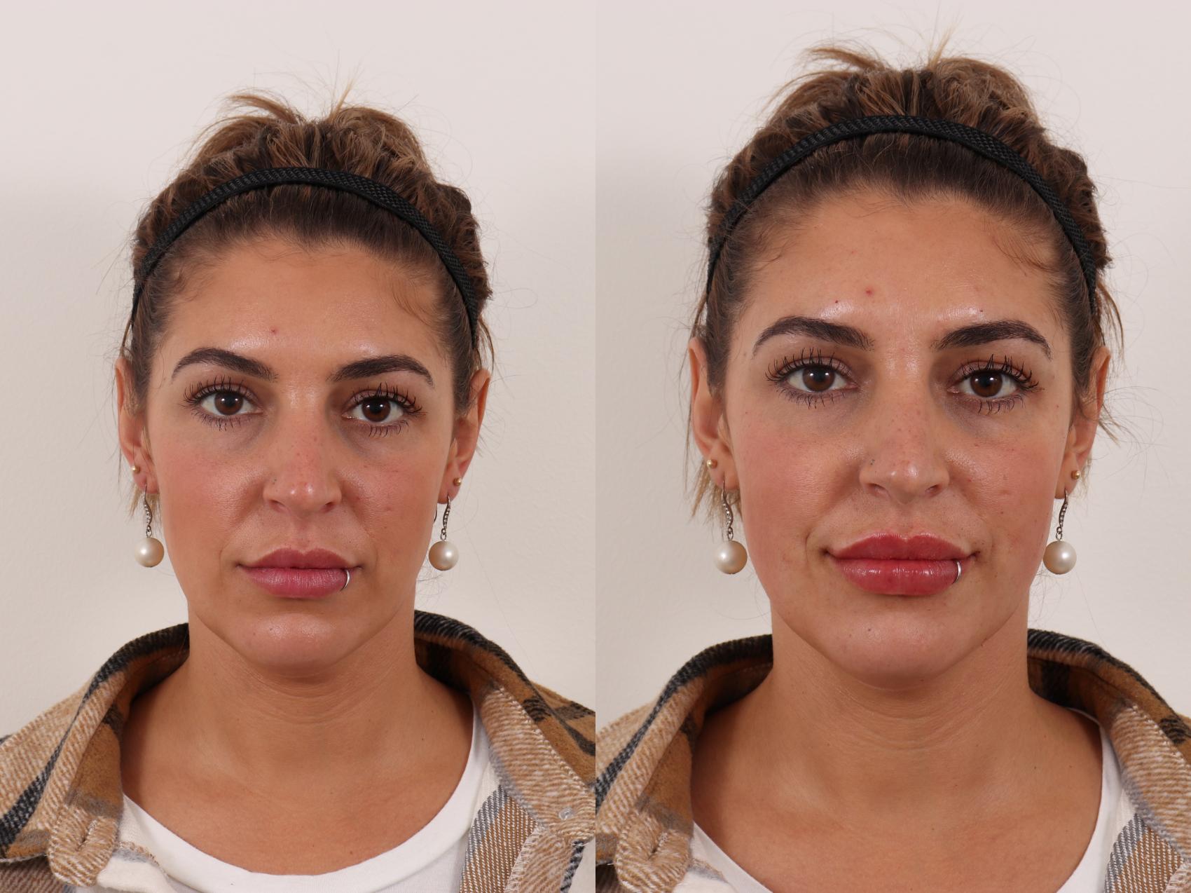 Lip filler before and after 