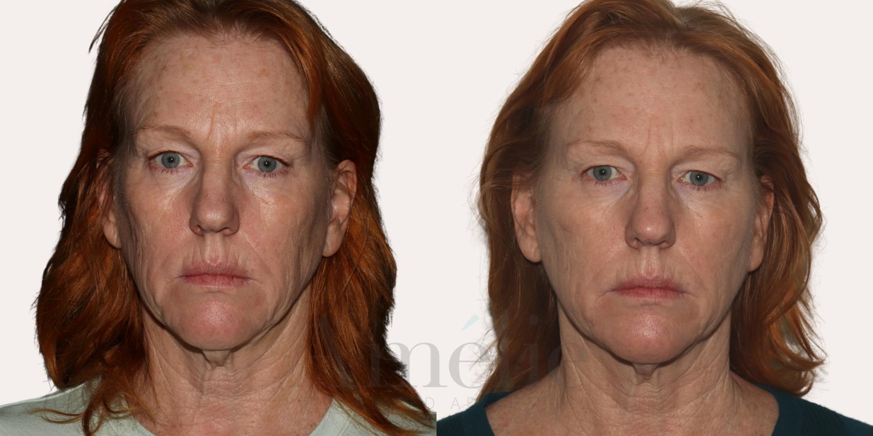 Sculptra full face before and after