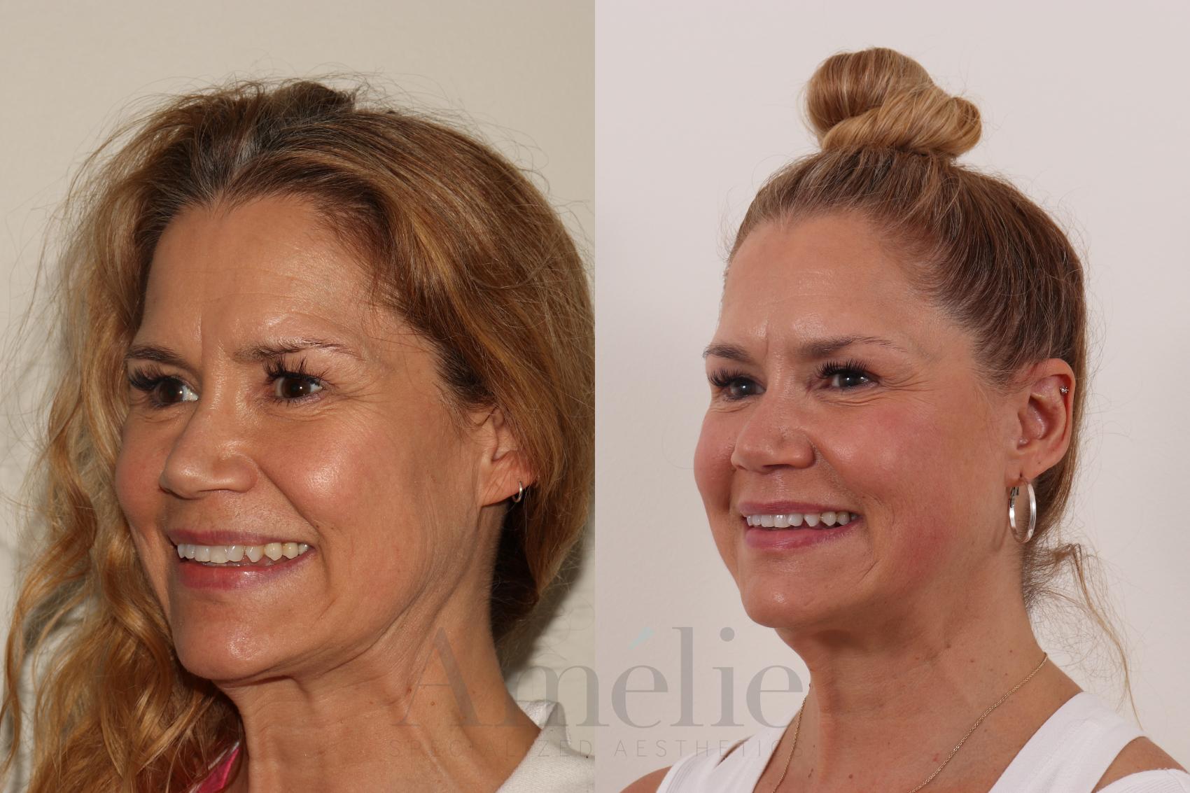 Sculptra and skincare before and after 