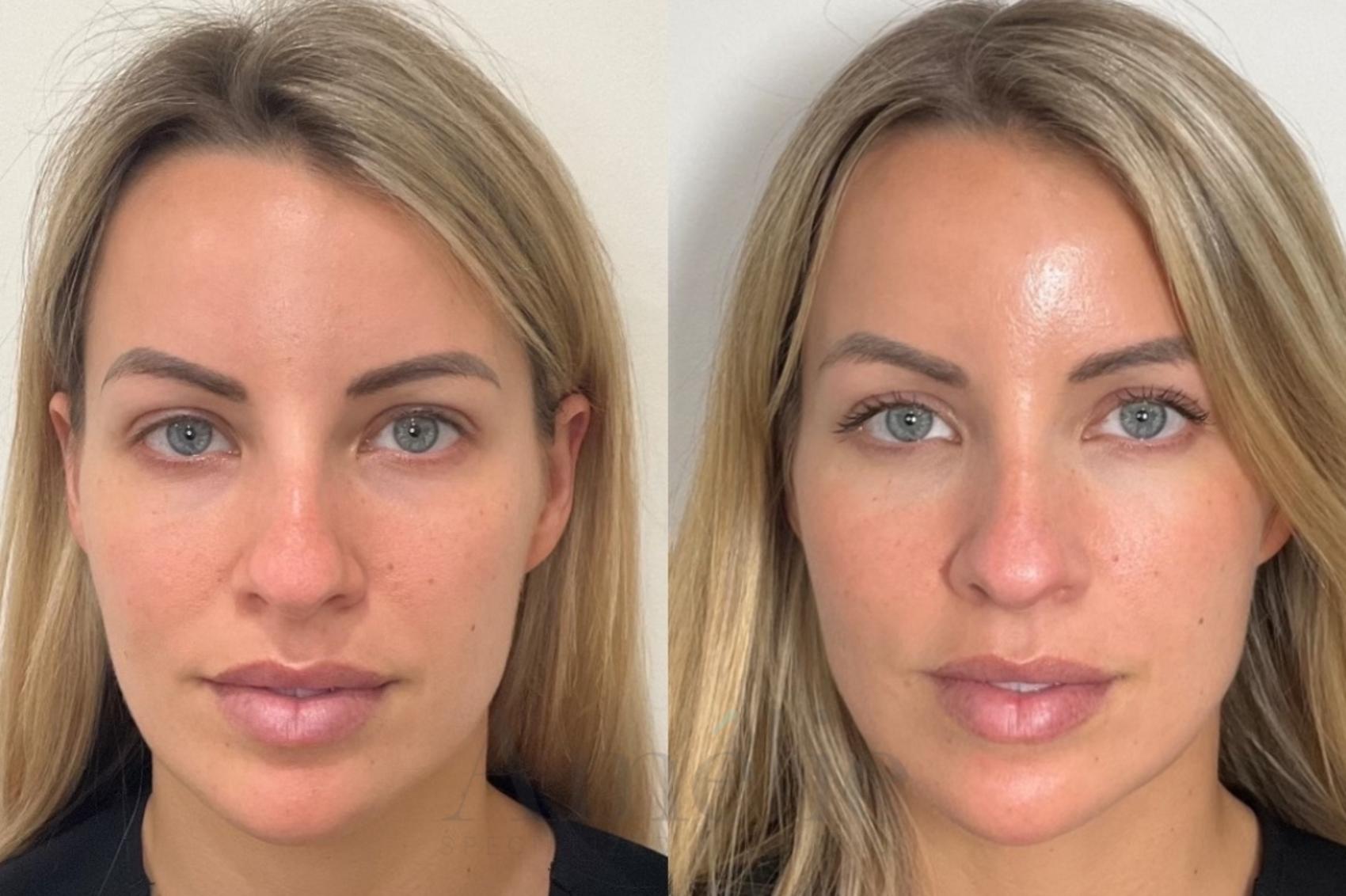 PRF and Sculptra Results 