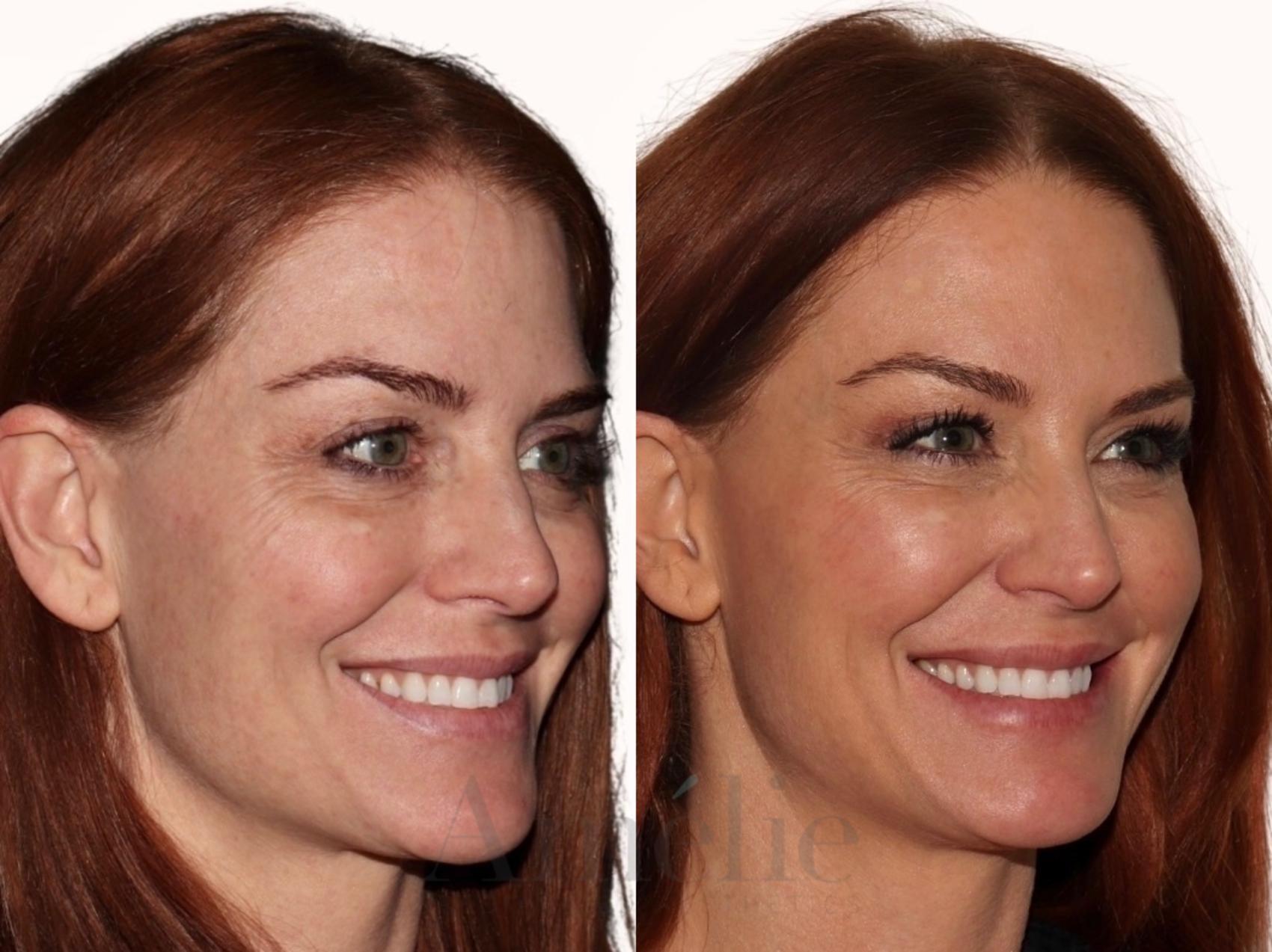 Sculptra before and after right side 
